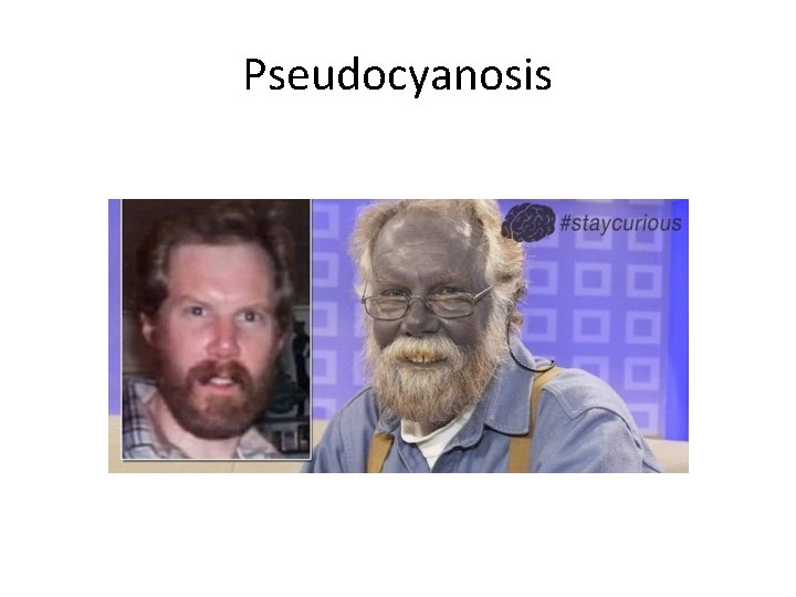 Pseudocyanosis 