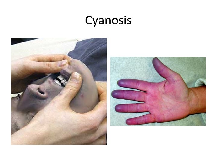 Cyanosis 