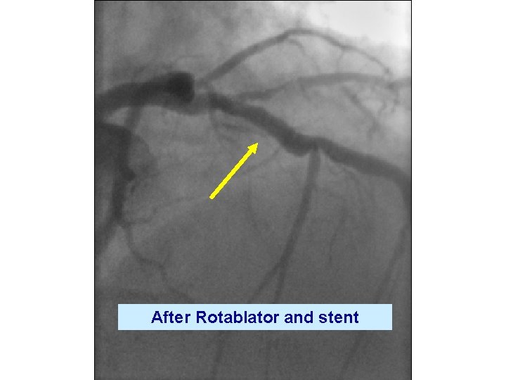 After Rotablator and stent 