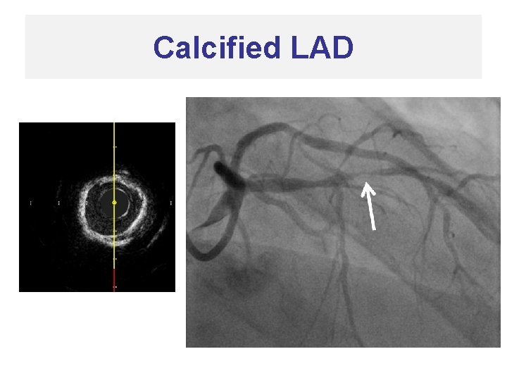 Calcified LAD 