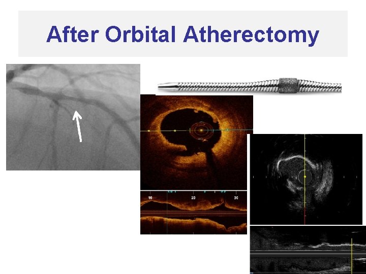 After Orbital Atherectomy 