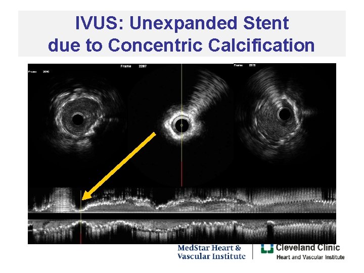 IVUS: Unexpanded Stent due to Concentric Calcification 