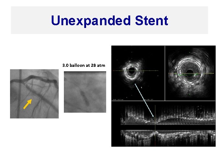 Unexpanded Stent 3. 0 balloon at 28 atm 