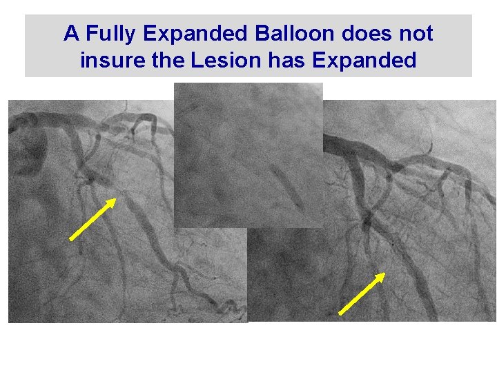 A Fully Expanded Balloon does not insure the Lesion has Expanded 3. 0 mm