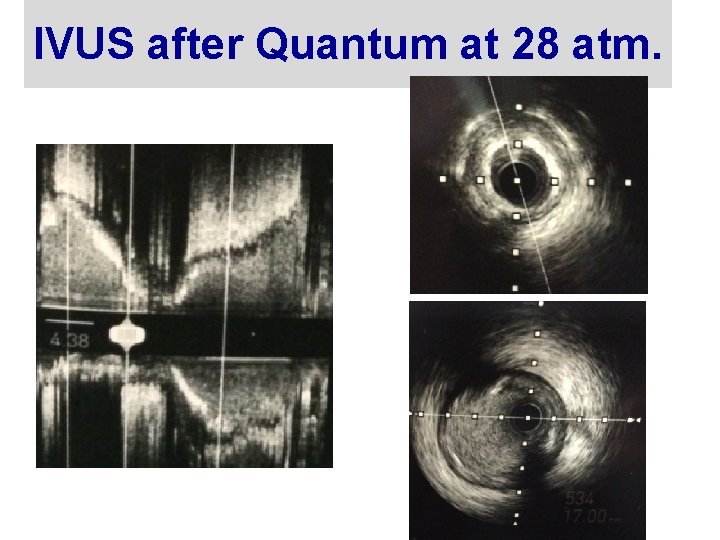 IVUS after Quantum at 28 atm. 