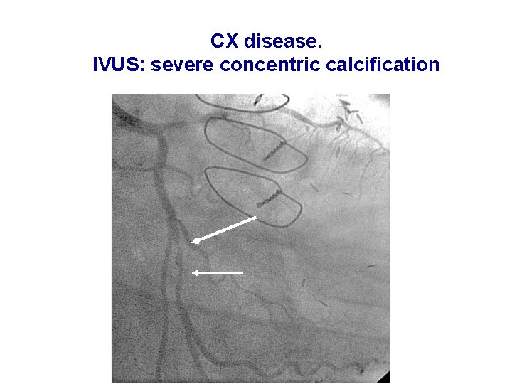 CX disease. IVUS: severe concentric calcification 