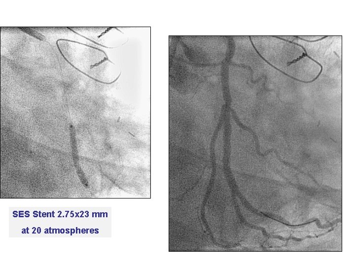SES Stent 2. 75 x 23 mm at 20 atmospheres 