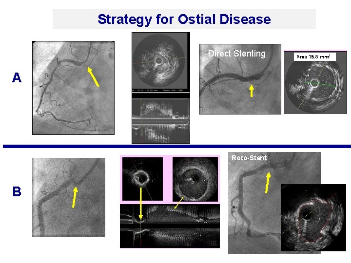 Strategy for Ostial Disease Direct Stenting A 5 m m Roto-Stent B 