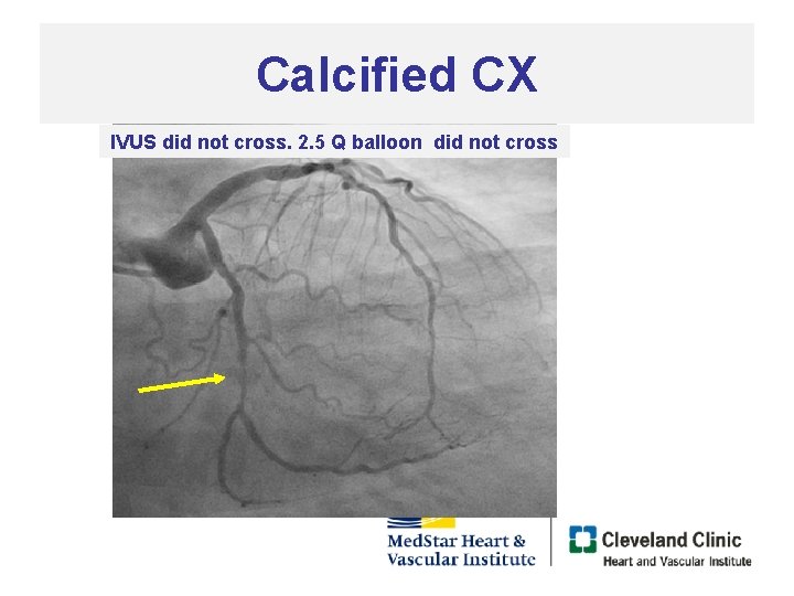 Calcified CX IVUS did not cross. 2. 5 Q balloon did not cross 