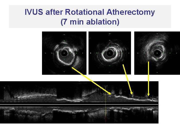 IVUS after Rotational Atherectomy (7 min ablation) 
