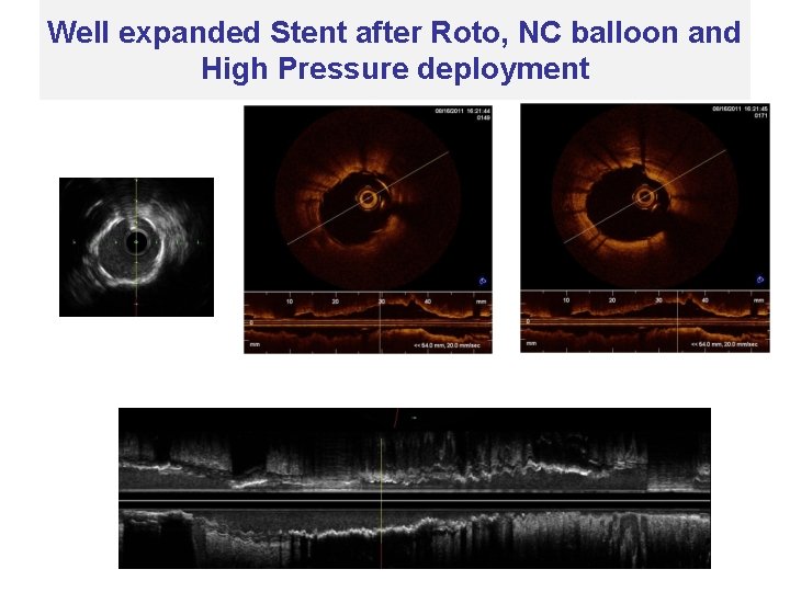 Well expanded Stent after Roto, NC balloon and High Pressure deployment 