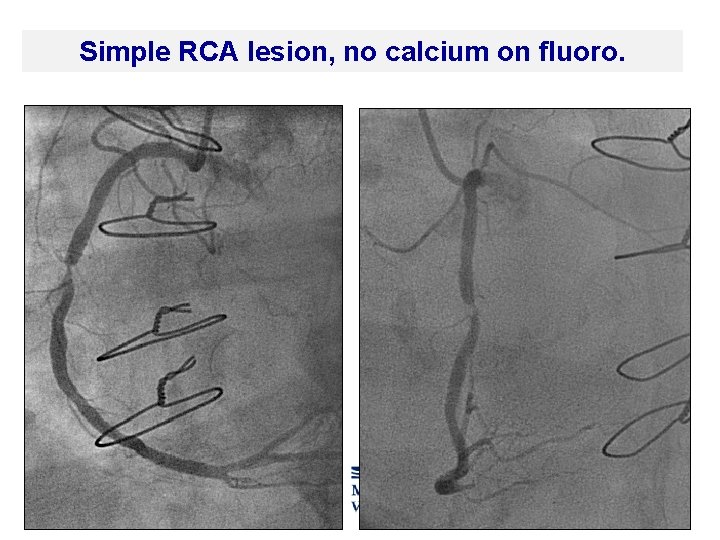 Simple RCA lesion, no calcium on fluoro. 