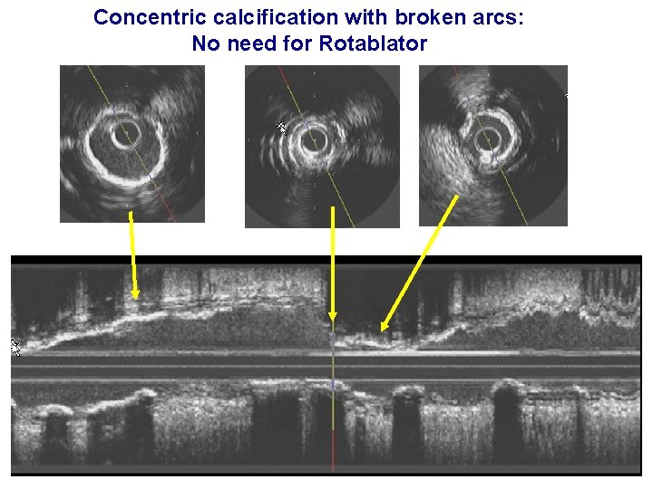 Concentric calcification with broken arcs: No need for Rotablator 