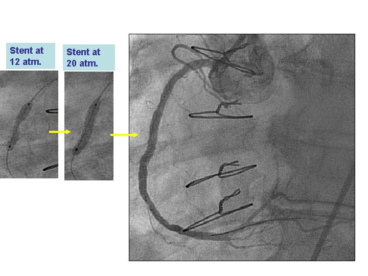 Stent at 12 atm. Stent at 20 atm. 