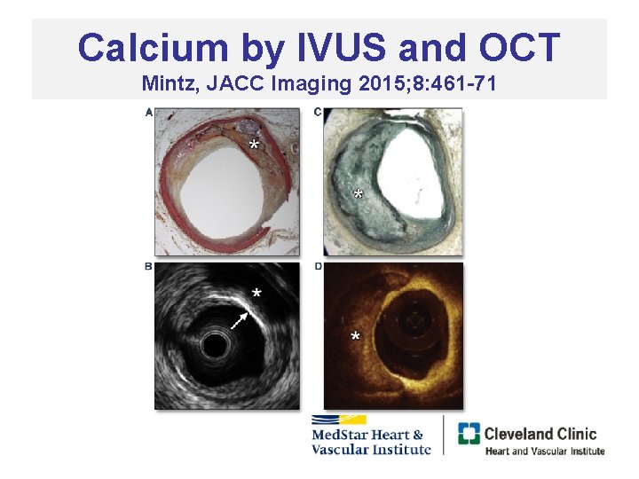 Calcium by IVUS and OCT Mintz, JACC Imaging 2015; 8: 461 -71 