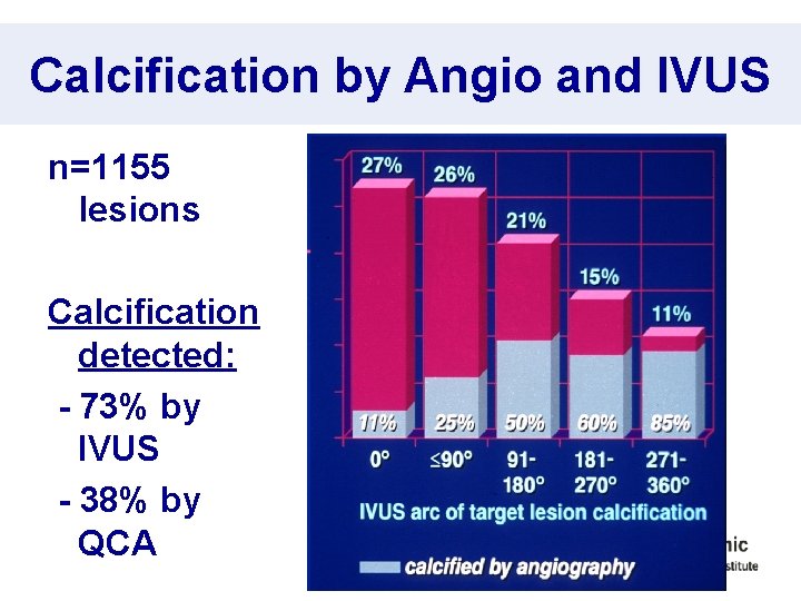 Calcification by Angio and IVUS n=1155 lesions Calcification detected: - 73% by IVUS -