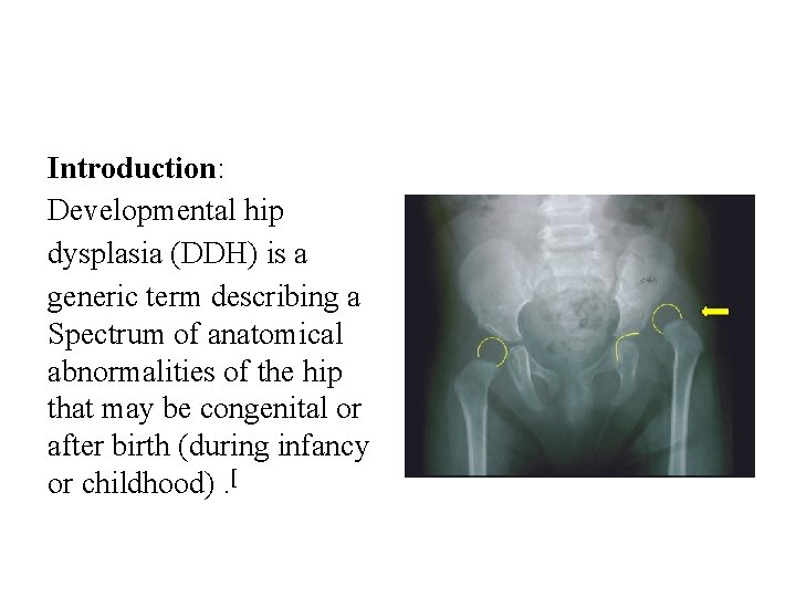 Introduction: Developmental hip dysplasia (DDH) is a generic term describing a Spectrum of anatomical