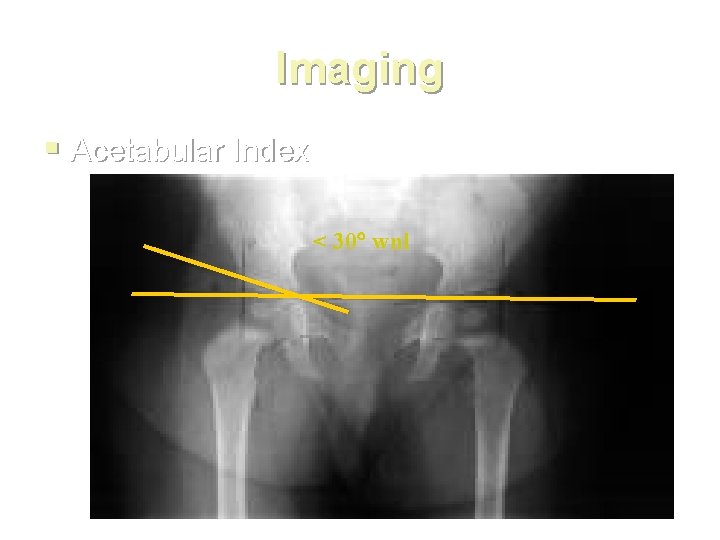 Imaging § Acetabular Index < 30 wnl 