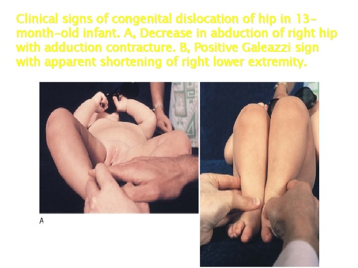 Clinical signs of congenital dislocation of hip in 13 month-old infant. A, Decrease in