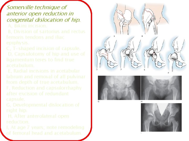 Somerville technique of anterior open reduction in congenital dislocation of hip. A, Bikini incision.