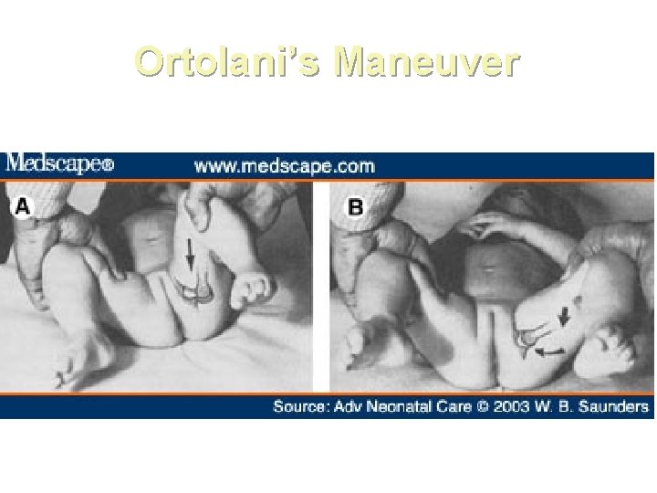 Ortolani’s Maneuver * After 3 months of age tests become negative 