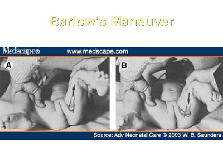 Barlow’s Maneuver 