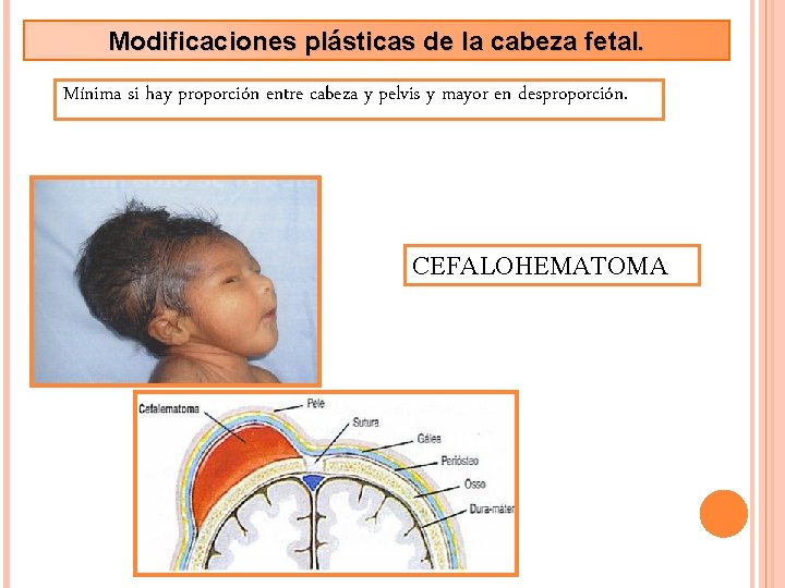 Modificaciones plásticas de la cabeza fetal. Mínima si hay proporción entre cabeza y pelvis