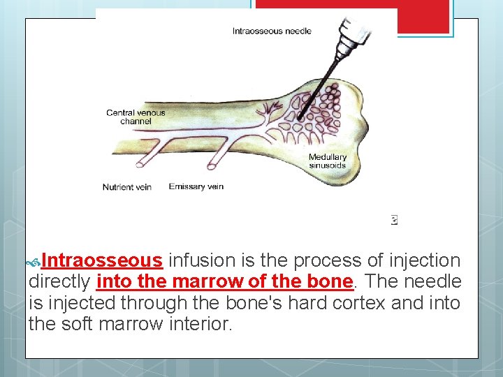  Intraosseous infusion is the process of injection directly into the marrow of the