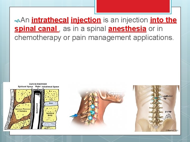  An intrathecal injection is an injection into the spinal canal , as in