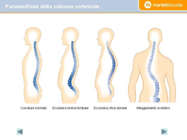 Paramorfismi della colonna vertebrale Curvatura normale Eccessiva lordosi lombare Eccessiva cifosi dorsale Atteggiamento scoliotico