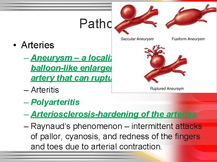Pathology • Arteries – Aneurysm – a localized weak spot or balloon-like enlargement of