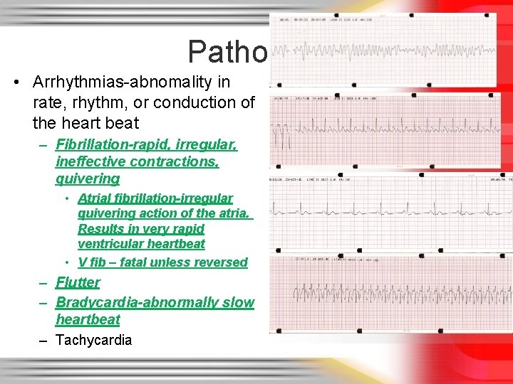 Pathology • Arrhythmias-abnomality in rate, rhythm, or conduction of the heart beat – Fibrillation-rapid,