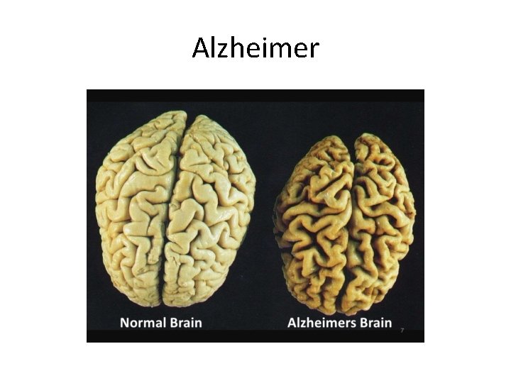 Alzheimer 