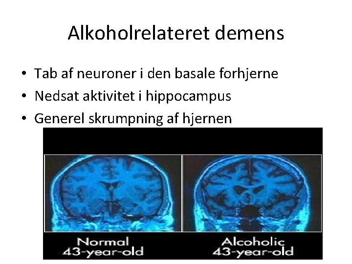 Alkoholrelateret demens • Tab af neuroner i den basale forhjerne • Nedsat aktivitet i
