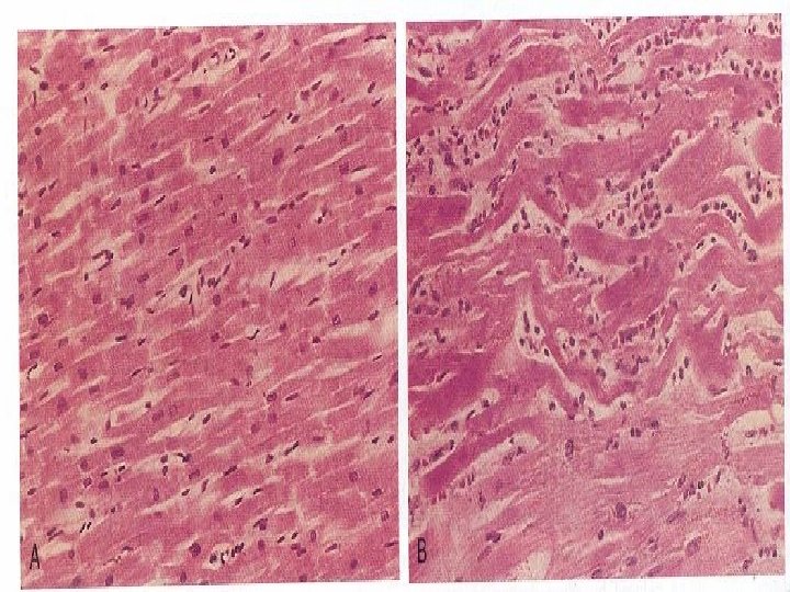 Myocardium photomic 