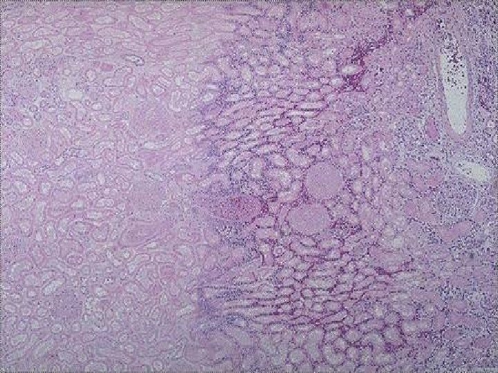 3 stages of coagulative necrosis (L to R) -- micro 