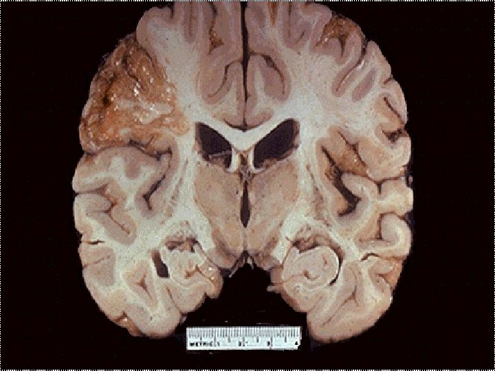 Liquefactive necrosis -- gross 