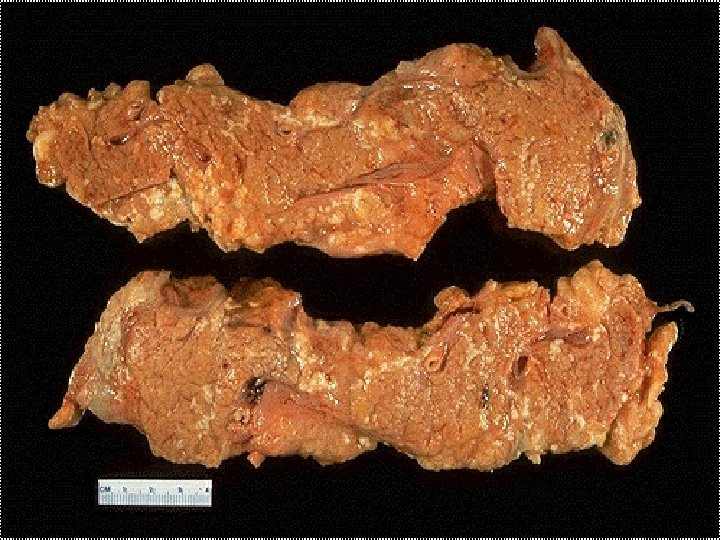 Enzymatic fat necrosis of pancreas -- gross 