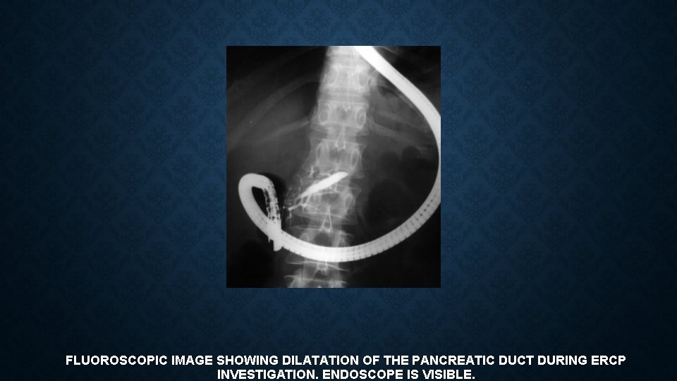 FLUOROSCOPIC IMAGE SHOWING DILATATION OF THE PANCREATIC DUCT DURING ERCP INVESTIGATION. ENDOSCOPE IS VISIBLE.