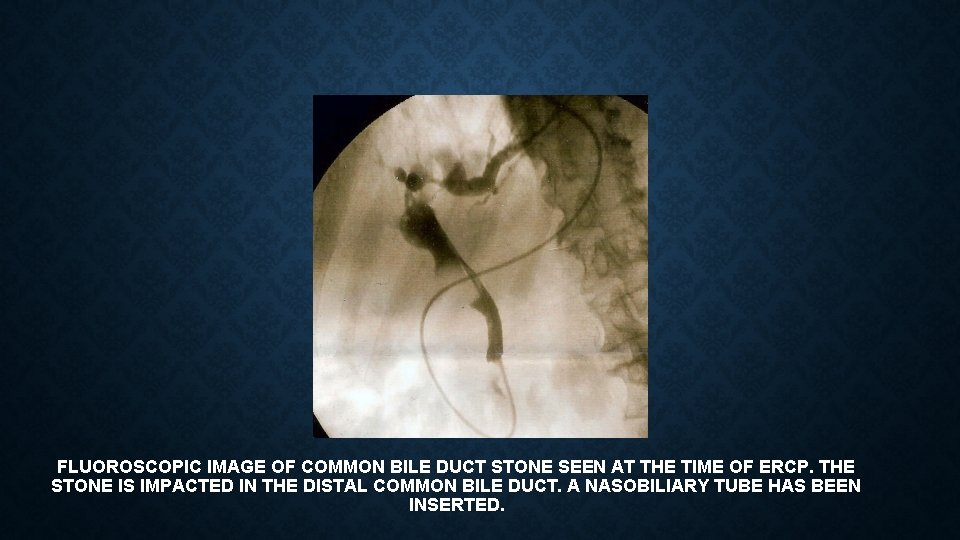 FLUOROSCOPIC IMAGE OF COMMON BILE DUCT STONE SEEN AT THE TIME OF ERCP. THE