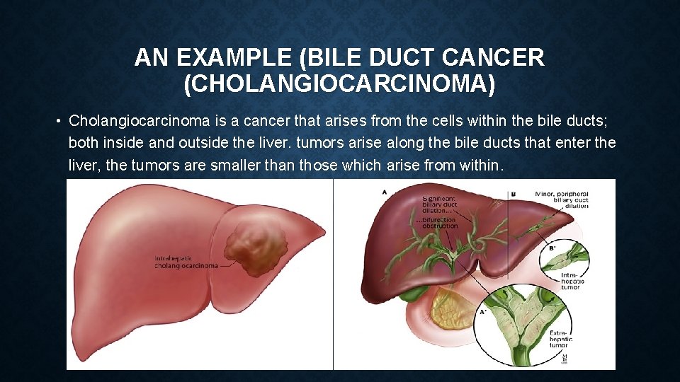 AN EXAMPLE (BILE DUCT CANCER (CHOLANGIOCARCINOMA) • Cholangiocarcinoma is a cancer that arises from