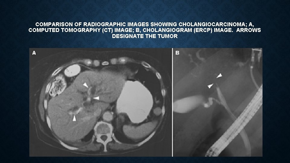 COMPARISON OF RADIOGRAPHIC IMAGES SHOWING CHOLANGIOCARCINOMA; A, COMPUTED TOMOGRAPHY (CT) IMAGE; B, CHOLANGIOGRAM (ERCP)