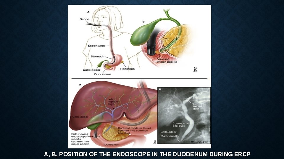 A, B, POSITION OF THE ENDOSCOPE IN THE DUODENUM DURING ERCP 