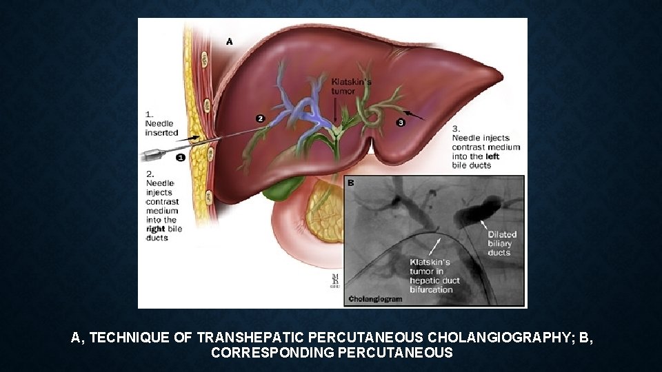 A, TECHNIQUE OF TRANSHEPATIC PERCUTANEOUS CHOLANGIOGRAPHY; B, CORRESPONDING PERCUTANEOUS 