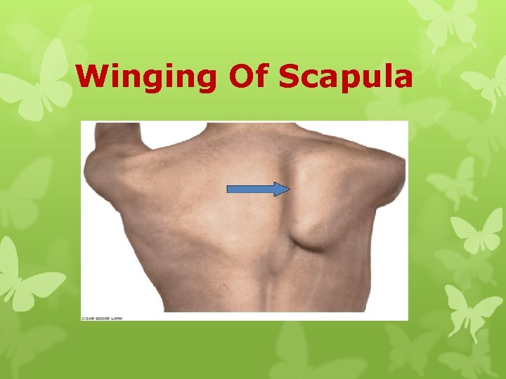 Winging Of Scapula 