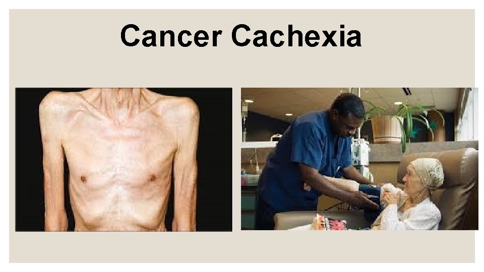 Cancer Cachexia 