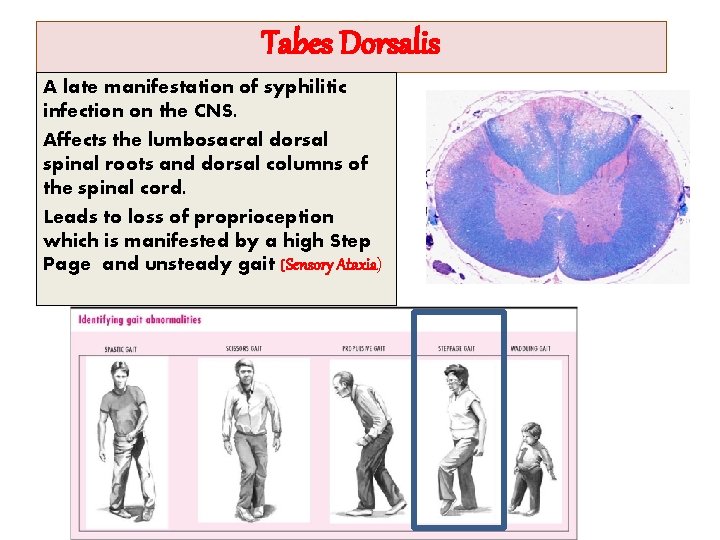 Tabes Dorsalis A late manifestation of syphilitic infection on the CNS. Affects the lumbosacral