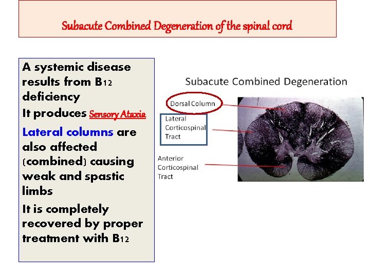 Subacute Combined Degeneration of the spinal cord A systemic disease results from B 12