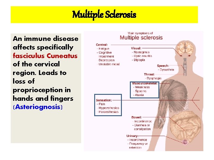 Multiple Sclerosis An immune disease affects specifically fasciculus Cuneatus of the cervical region. Leads