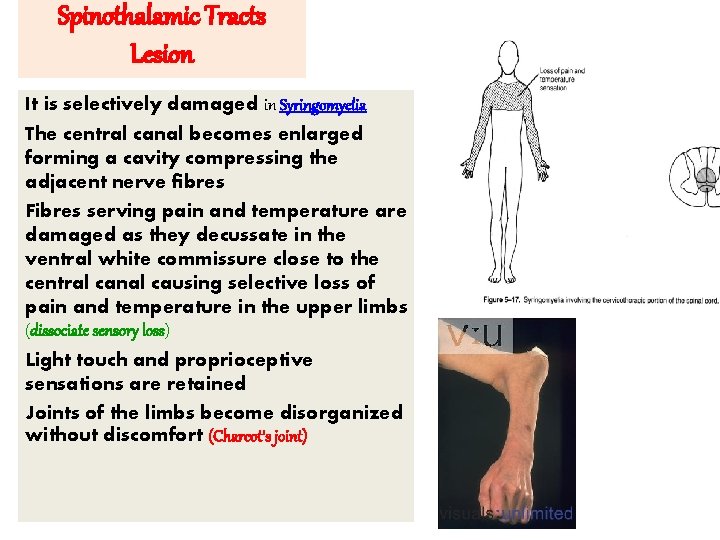 Spinothalamic Tracts Lesion It is selectively damaged in Syringomyelia The central canal becomes enlarged